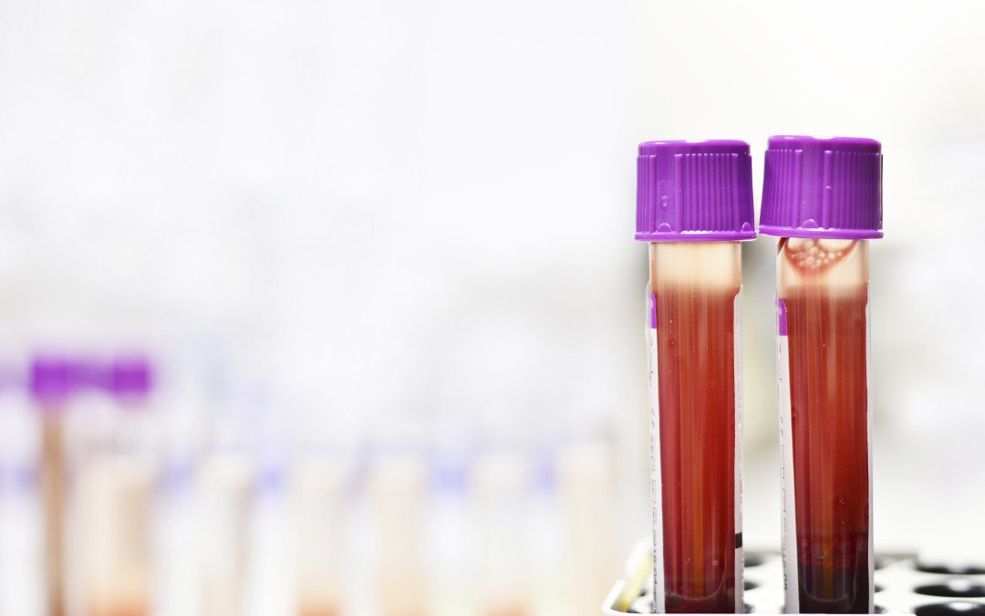 La leucemia mieloide acuta