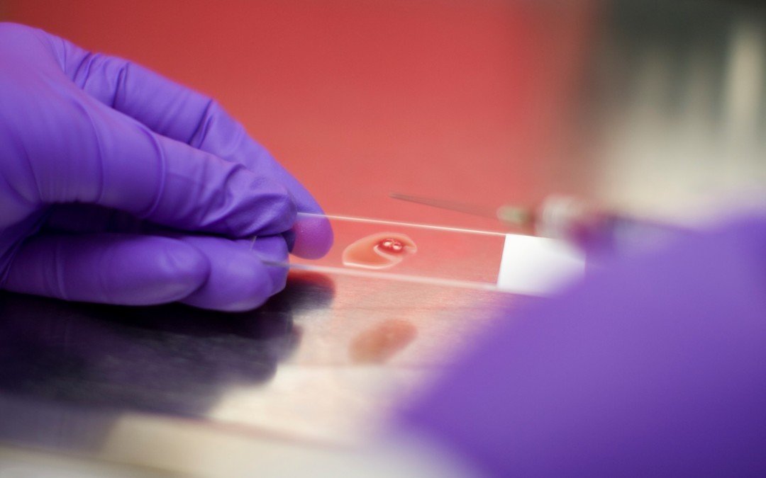 La leucemia linfatica cronica