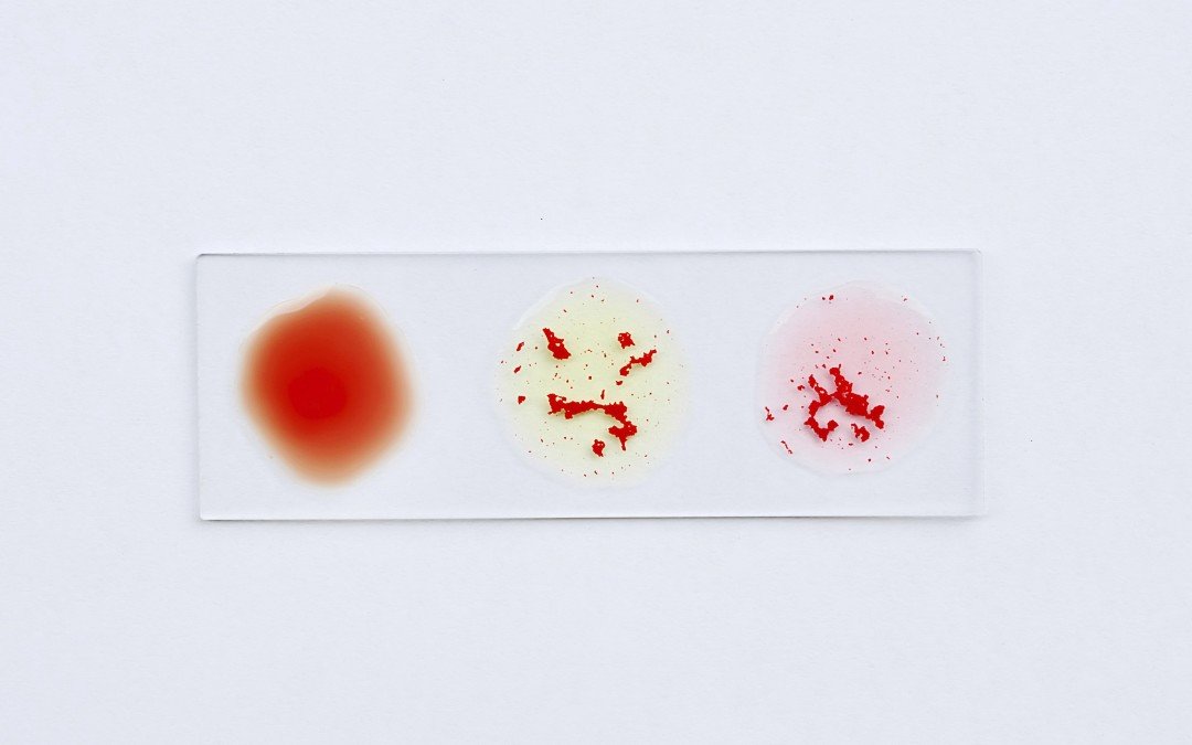 La leucemia linfoblastica acuta